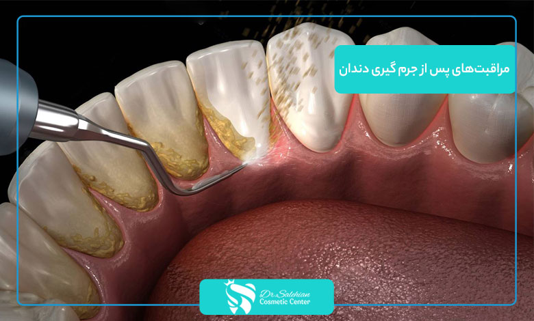 مراقبت‌های پس از جرم گیری دندان