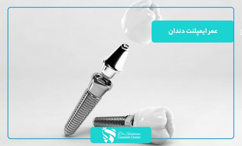 عمر ایمپلنت دندان