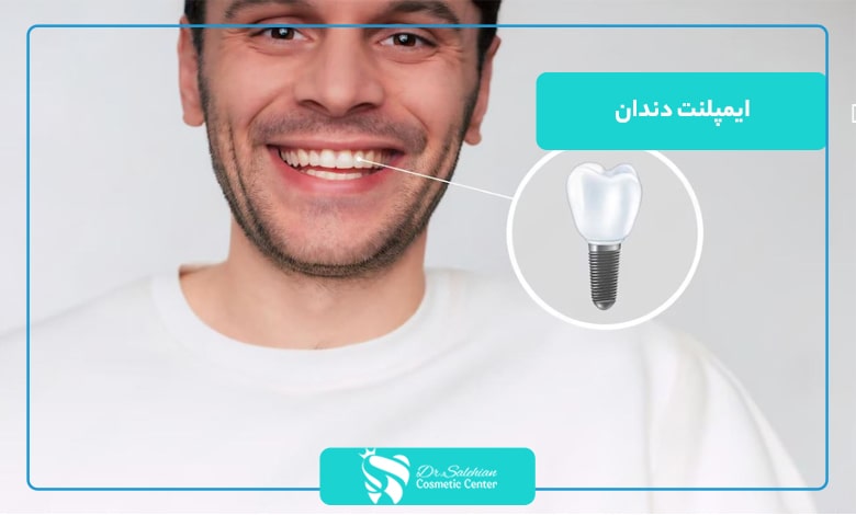 ایمپلنت دندان