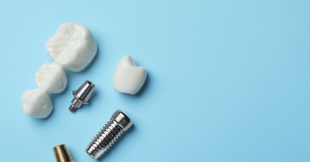 ایمپلنت دندان