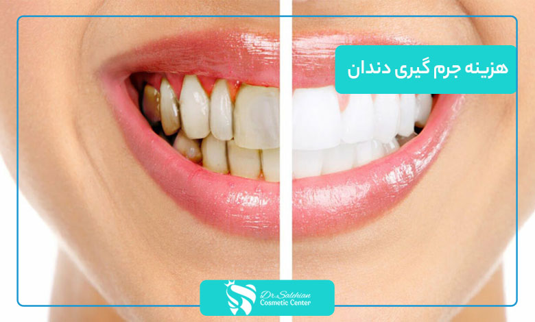 هزینه جرم‌ گیری دندان