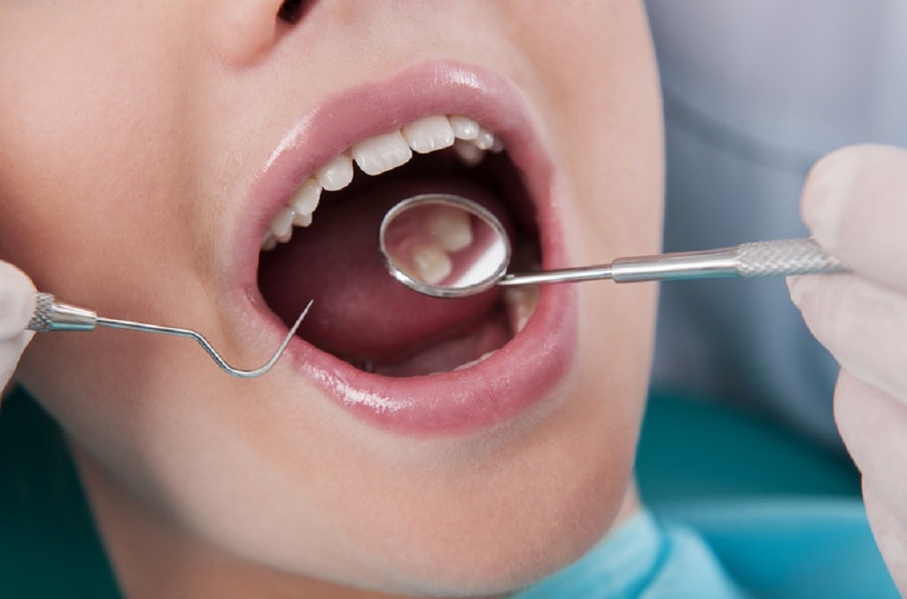 پرکردن دندان