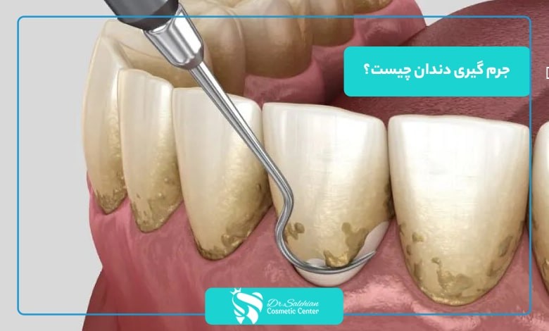 جرم گیری دندان چیست