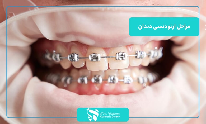 مراحل ارتودنسی