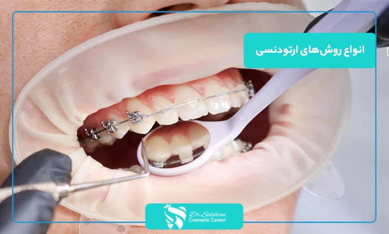 انواع روش های ارتودنسی دندان