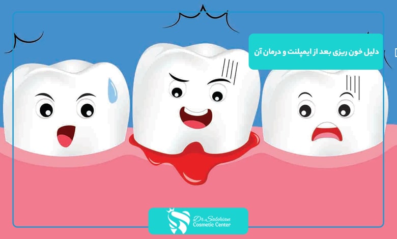 دلیل خون ریزی بعد از ایمپلنت و درمان آن