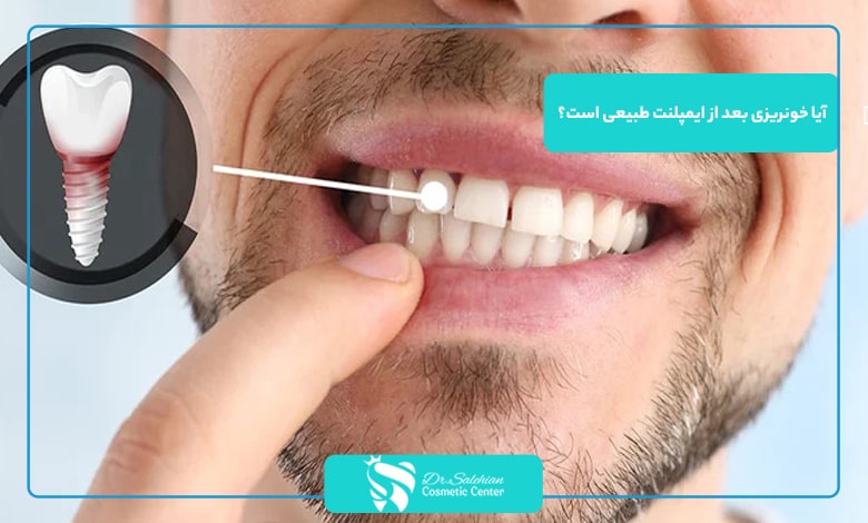 آیا خونریزی بعد از ایمپلنت طبیعی است؟