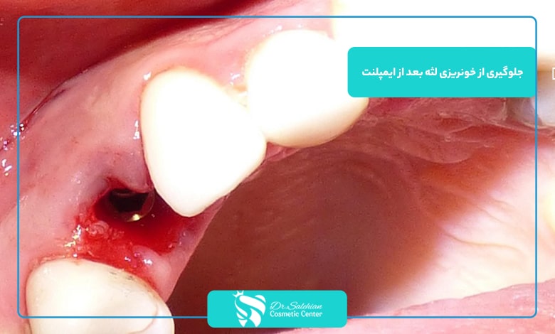 جلوگیری از خونریزی لثه بعد از ایمپلنت