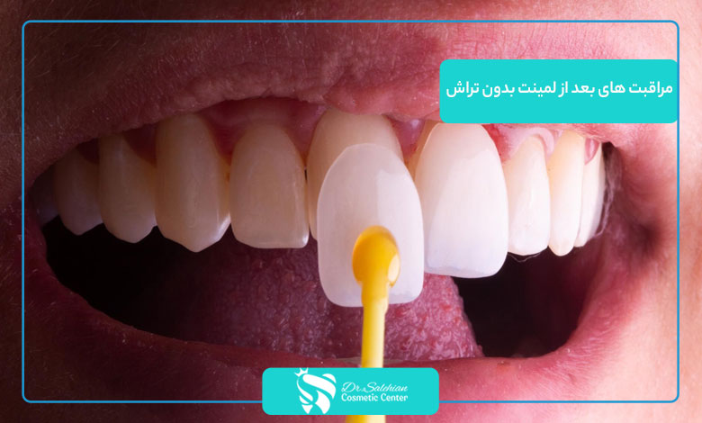 مراقبت های بعد از لمینت بدون تراش