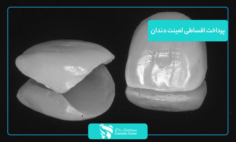 پرداخت اقساطی لمینت دندان
