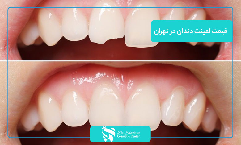 قیمت لمینت دندان در تهران