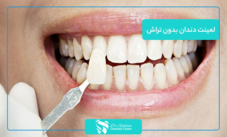 لمینت دندان بدون تراش