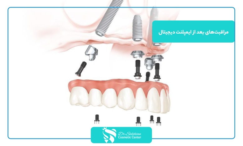 مراقبت‌های بعد از کاشت ایمپلنت دیجیتال