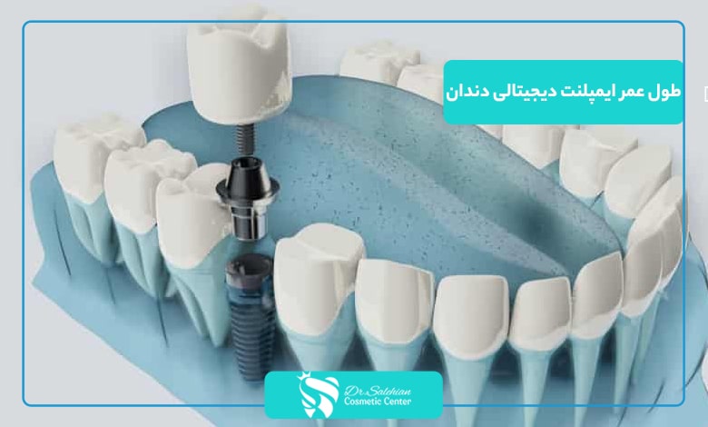 طول عمر ایمپلنت دیجیتالی دندان چقدر است؟