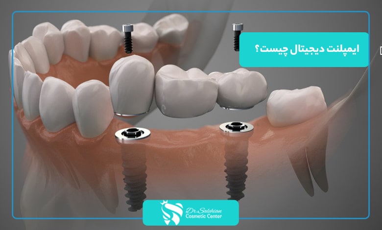 ایمپلنت دیجیتال چیست و چه تفاوتی با ایمپلنت معمولی دارد؟