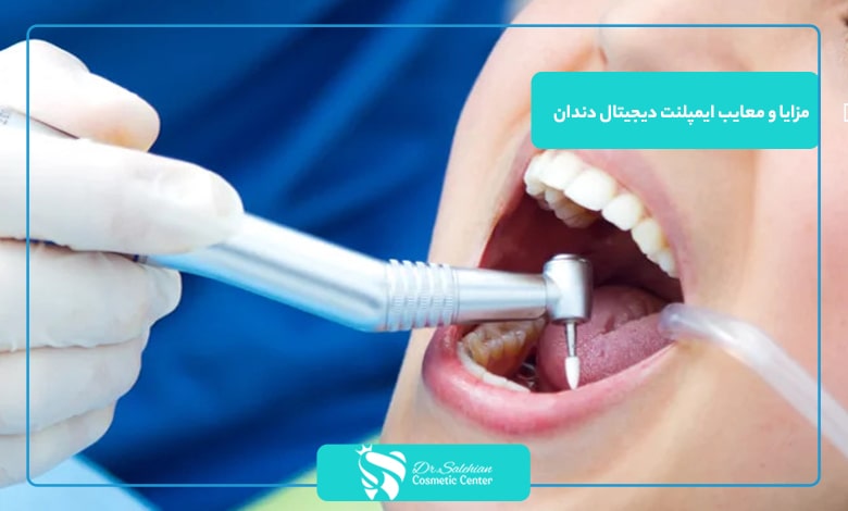 مزایا و معایب ایمپلنت دیجیتال دندان