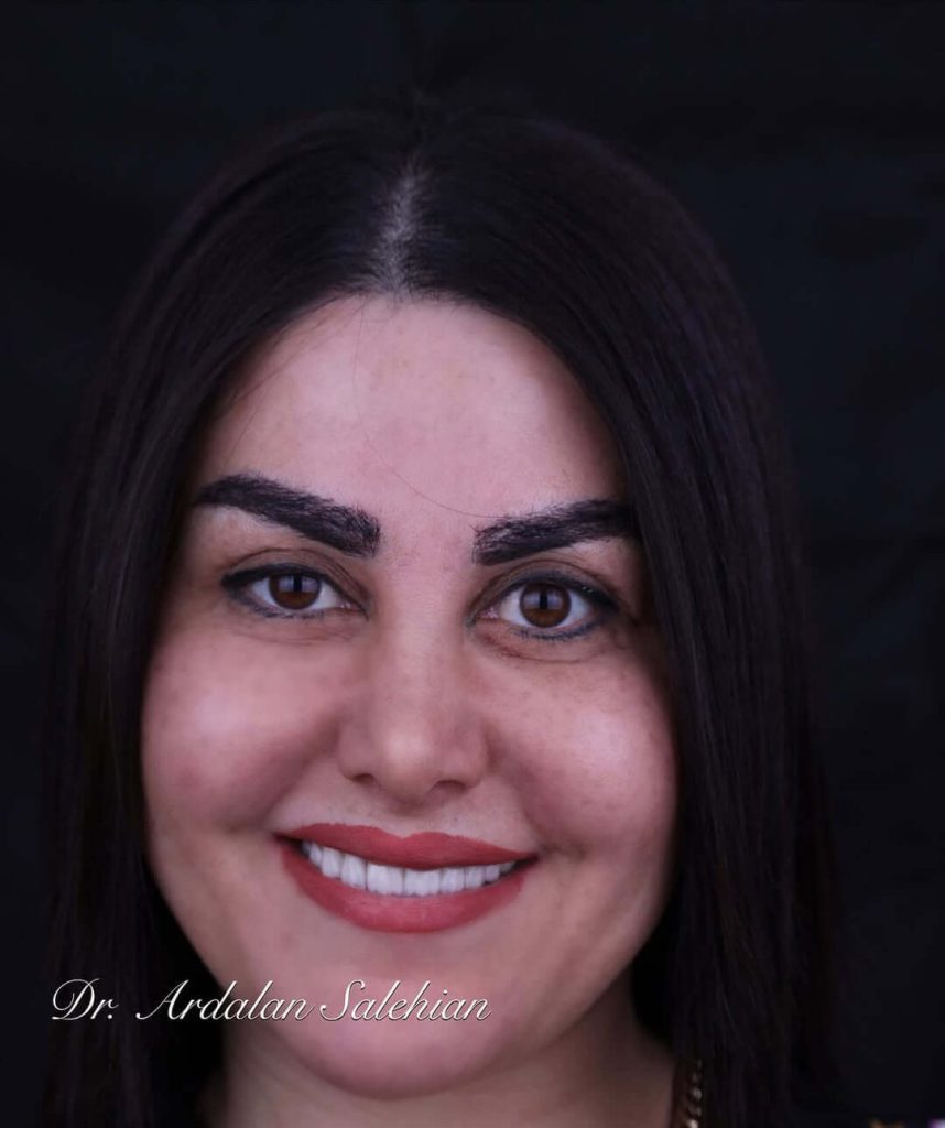 نمونه کار لمینت دندان توسط دکتر صالحیان