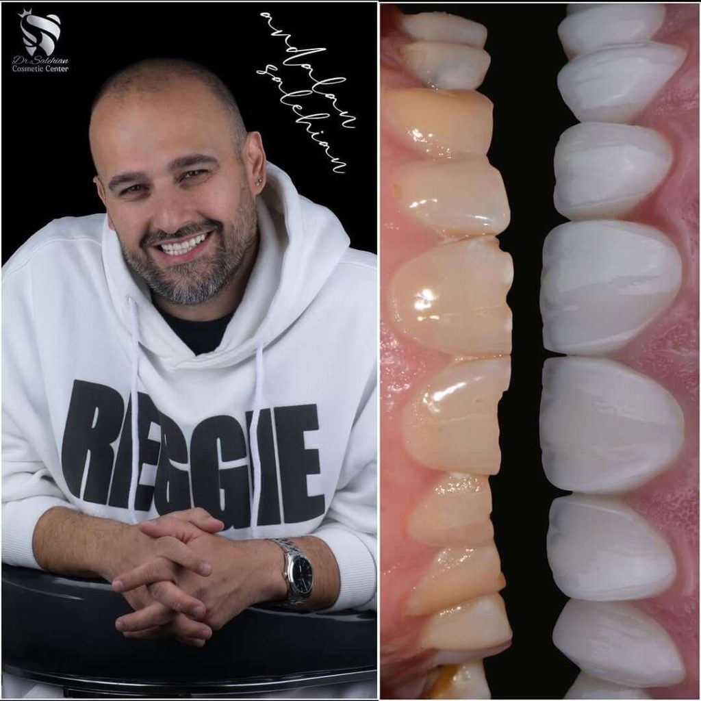 نمونه کار لمینت دندان توسط دکتر صالحیان