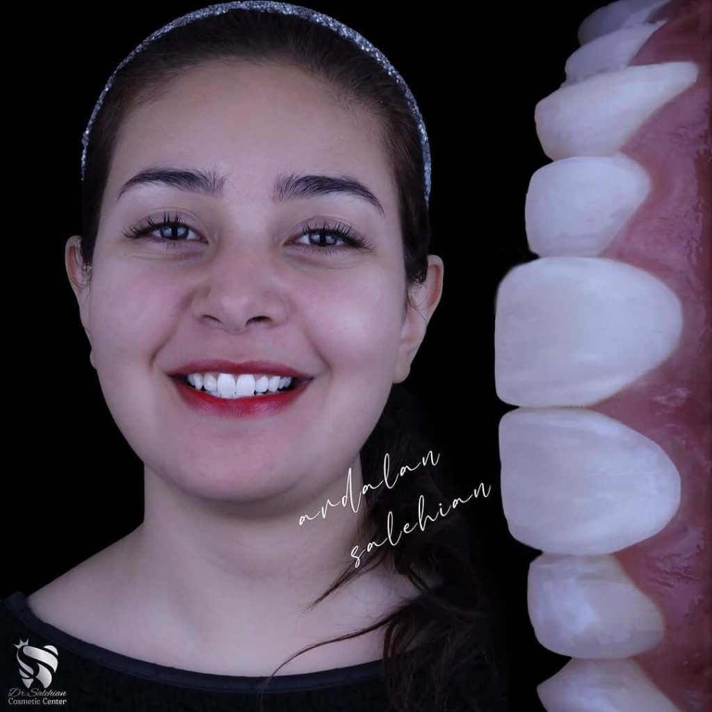 نمونه کار لمینت دندان توسط دکتر صالحیان