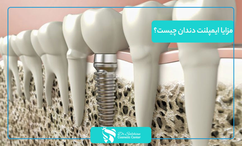 مزایا ایمپلنت دندان چیست؟