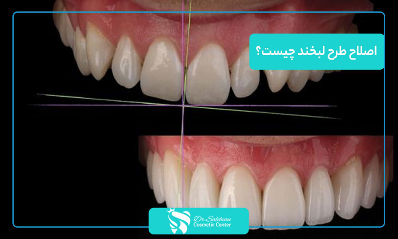 اصلاح طرح لبخند چیست؟