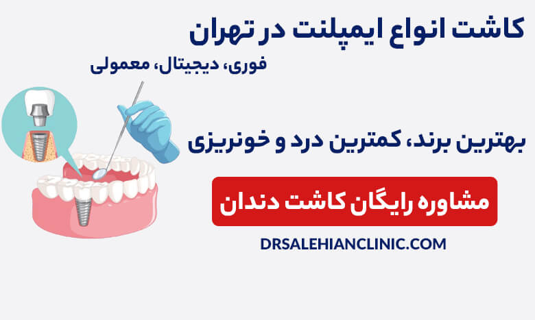 مشاوره رایگان کاشت دندان