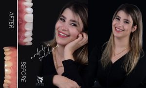 بلیچینگ دندان در تهران
