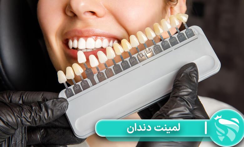 لمینت دندان چیست؟