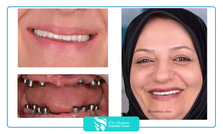 نمونه کار ایمپلنت دندان دکتر صالحیان