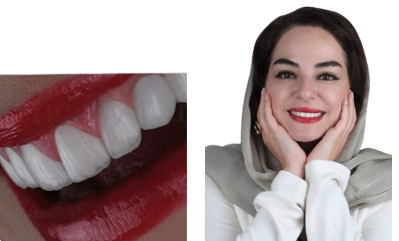 نمونه کار لمینت دندان توسط دکتر صالحیان