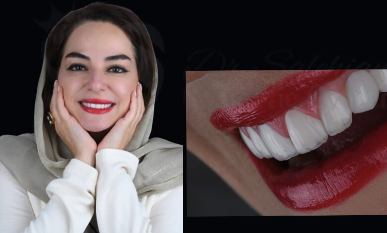 چه کسانی لمینت دندان بکنند