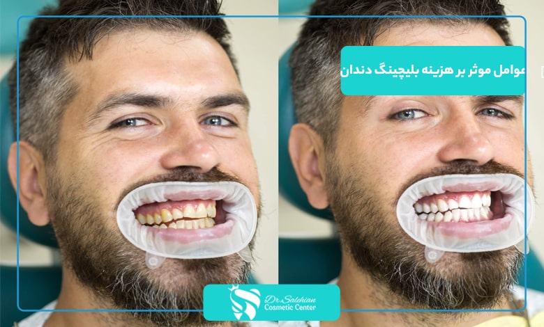 عوامل موثر بر هزینه بلیچینگ دندان