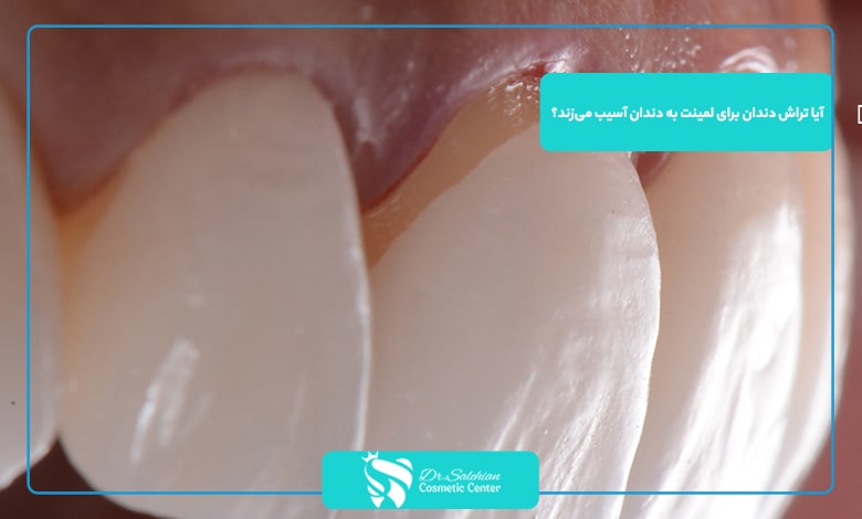 آیا تراش دندان برای لمینت به دندان آسیب می‌زند؟