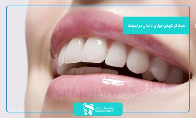 علت تراشیدن مینای دندان در لمینت
