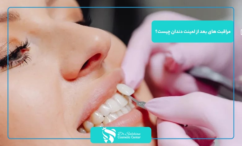 مراقبت های بعد از لمینت دندان