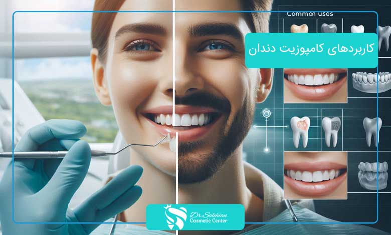 کاربردهای کامپوزیت دندان