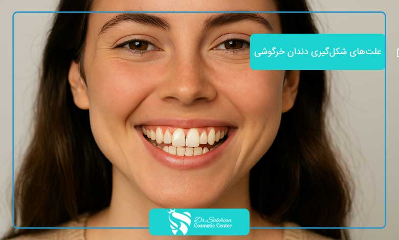 لمینت دندان خرگوشی چیست