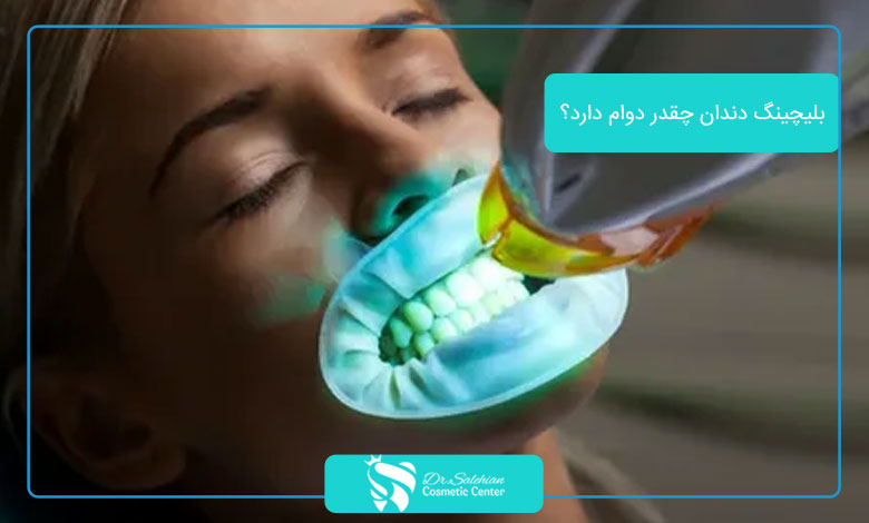 بلیچینگ دندان چقدر دوام دارد