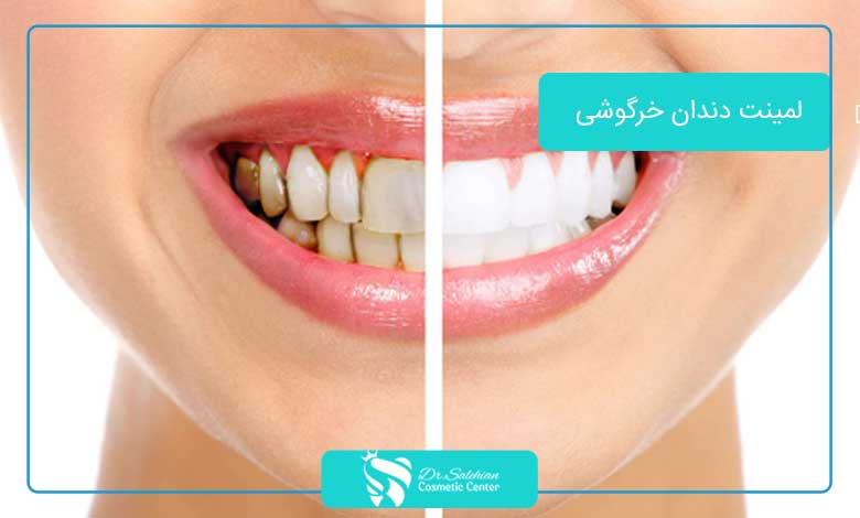 لمینت دندان خرگوشی