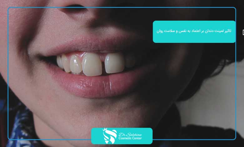 تاثیر لمینت دندان بر اعتماد به نفس و سلامت روان
