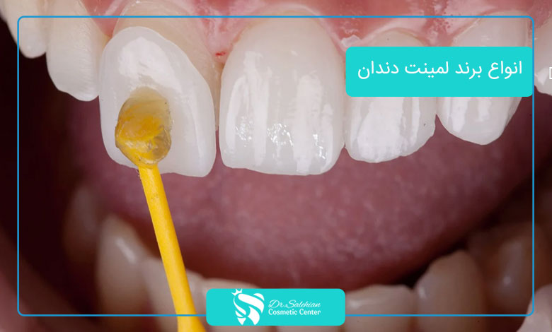 انواع برند لمینت دندان