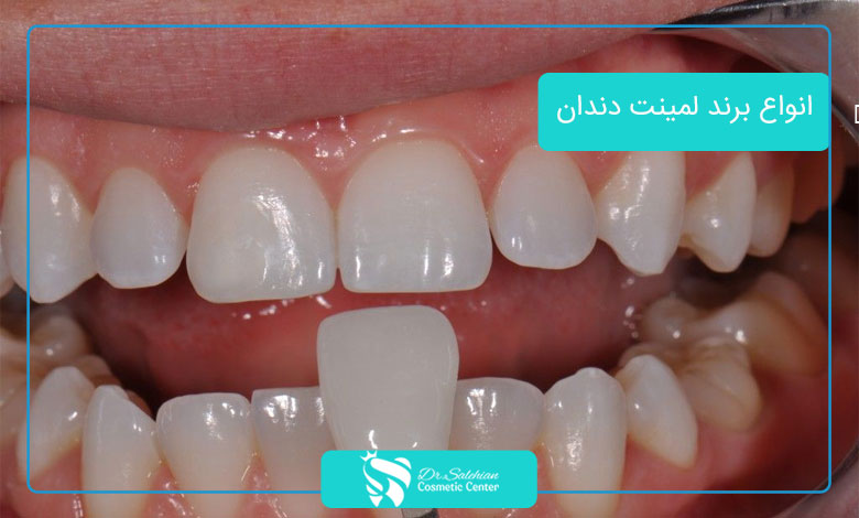 انواع لمینت دندان بر اساس ماندگاری و کاربرد