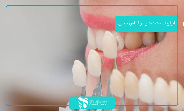 انواع لمینت دندان بر اساس جنس