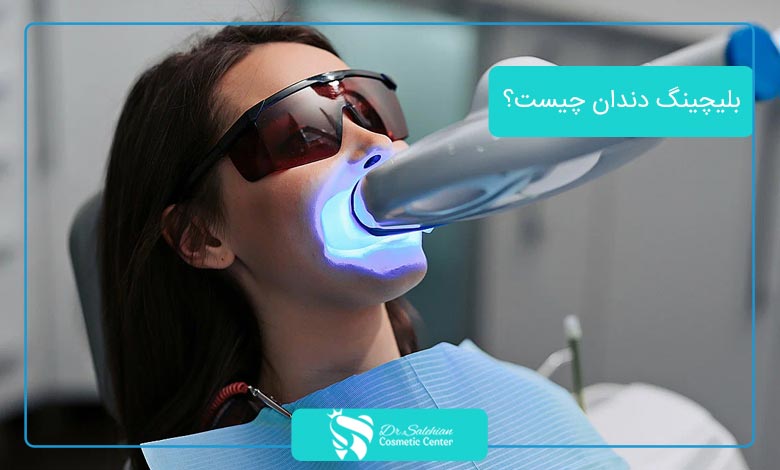 بلیچینگ دندان چیست