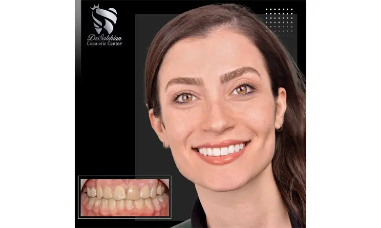نمونه کار واقعی کامپوزیت دندان با دکتر صالحیان