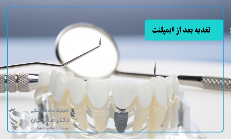 تغذیه مناسب در روزهای ابتدایی پس از کاشت ایمپلنت