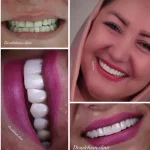 نمونه کار واقعی کامپوزیت دندان