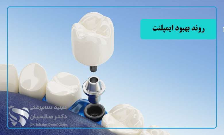 آشنایی با مراحل و روند بهبود ایمپلنت