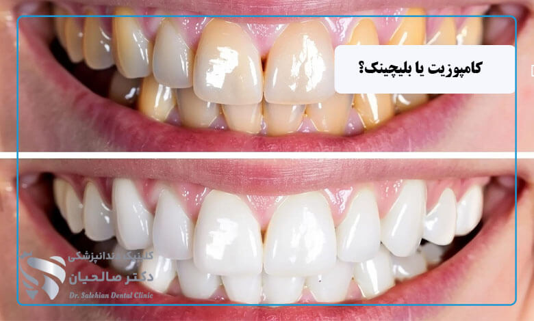 بلیچینگ بهتر است یا کامپوزیت؟