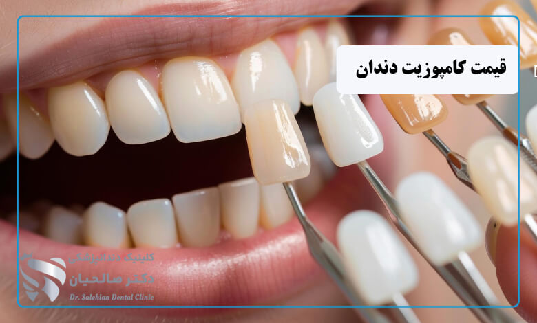قیمت کامپوزیت دندان